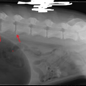Spondylose
